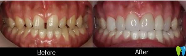 合肥壹加壹程红梅医生牙缝大做瓷贴面案例对比图