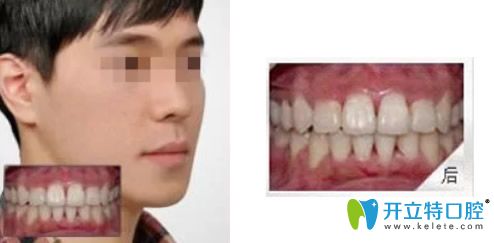 壹加壹口腔矫正牙齿两年后效果 壹加壹口腔矫正牙齿两年后效果