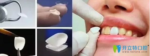 瓷贴面的粘结方法和步骤 瓷贴面的粘结方法和步骤