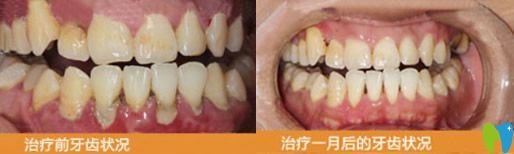 广泛型侵袭性牙周炎治疗前后对比图