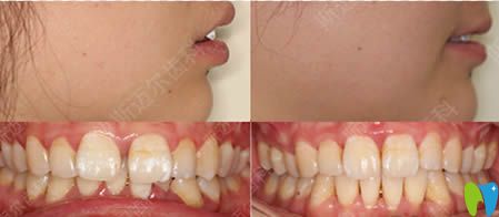 北京斯迈尔齿科牙缝宽大/龅牙矫正效果对比图
