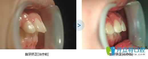 泉州维乐口腔龅牙矫正前后效果对比图 泉州维乐口腔龅牙矫正前后效果对比图