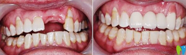 青岛马泷齿科种植牙修复案例
