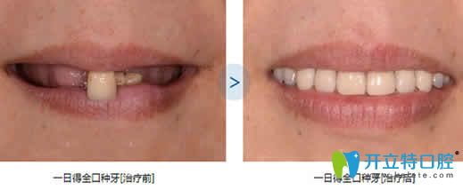 泉州维乐口腔全口种植牙前后对比图 泉州维乐口腔全口种植牙前后对比图