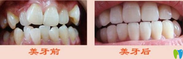 二氧化锆全瓷牙修复牙齿<span style= 二氧化锆全瓷牙修复牙齿<span style=