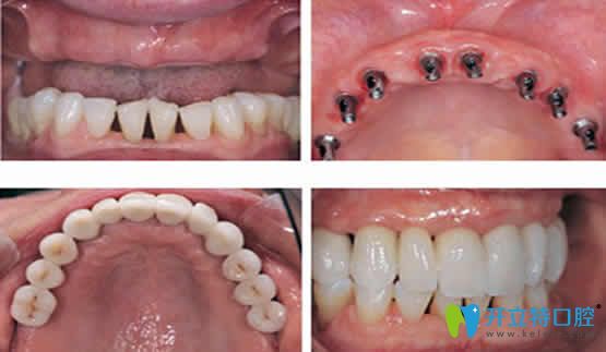 武汉优益佳口腔半口牙种植前后效果对比图