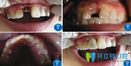 青岛天皓口腔门诊赵军医生种植牙案例效果对比图