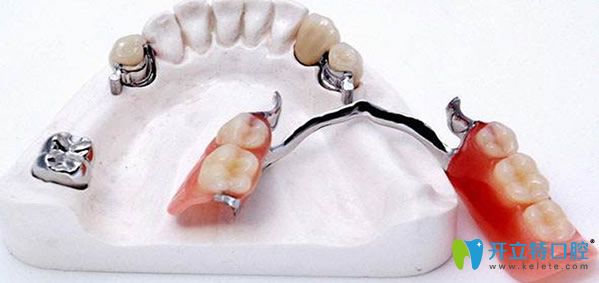 牙齿修复镶牙/烤瓷牙/种植牙哪个好 这里有你想要的答案