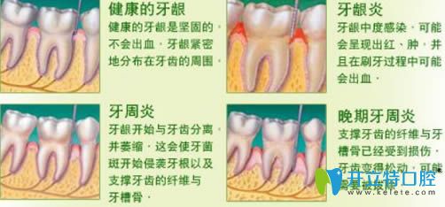 开立特有关牙周炎的详解图 开立特有关牙周炎的详解图