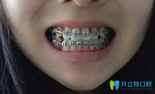 金属托槽矫正牙齿一年后效果怎么样