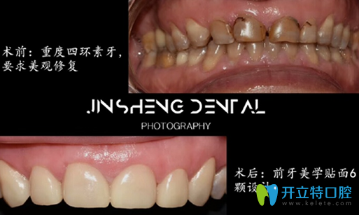王丽莹牙齿瓷贴面治疗前后对比图