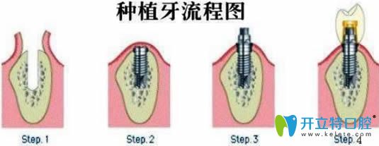 哈尔滨拜博口腔的徐旭光主任解说种植牙过程分为几个步骤