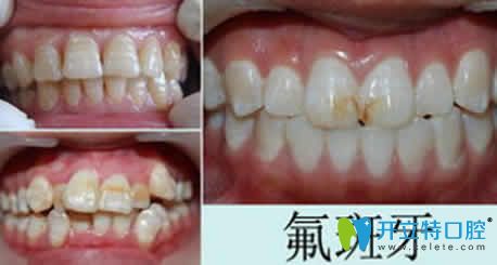 医生解惑：氟斑牙的治疗方法及治疗年龄