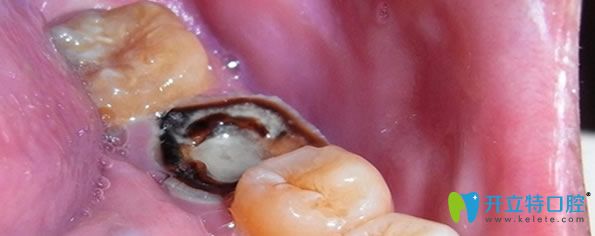 急性牙髓炎不治疗的后果