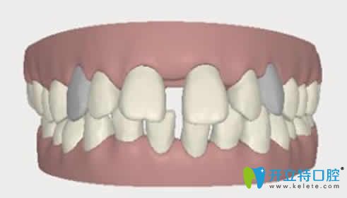 想请教下大家牙齿缝隙大怎么治疗，能做牙齿矫正吗？