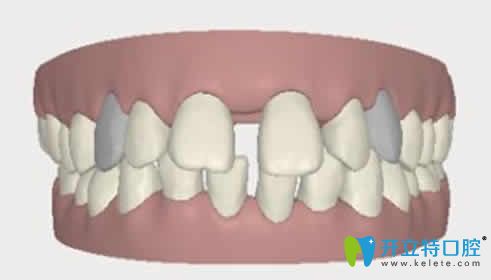 牙齿缝隙大怎么治疗