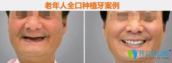 哈尔滨拜博60岁老人全口种植牙案例及1年后的感受
