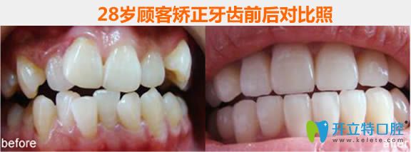 哈尔滨拜博口腔28岁隐适美矫正牙齿前后对比后效果照
