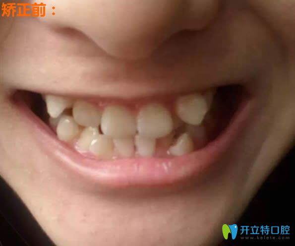 在上海美联臣口腔做牙齿矫正术前照
