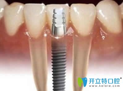 新疆凯乐口腔种植牙 新疆凯乐口腔种植牙