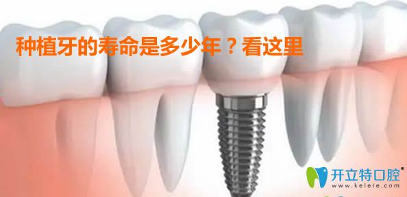 种植牙的寿命是几年?牙医建议镶牙不要种牙的秘密请看这里