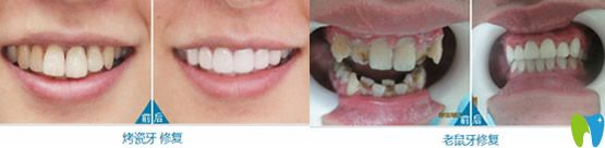 曙光口腔牙齿美容冠修复案例前后效果对比图