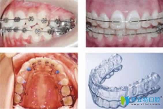 北京壹加壹口腔医生介绍牙齿稀疏牙缝大的矫正方法图