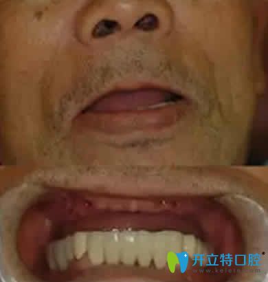 宁波现代口腔种植牙案例术前照