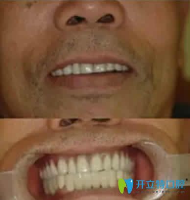6旬老人在宁波现代口腔做种植牙后照片