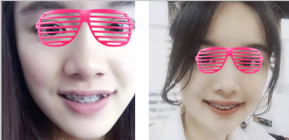 虎牙矫正 20岁妹子在上海维乐口腔带牙套1~12月变化图