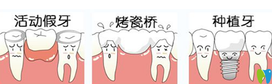 拔牙后多久可以镶牙和镶的牙齿有关