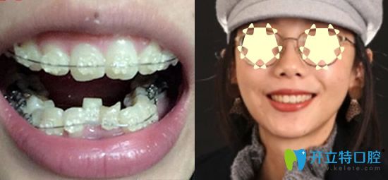重庆整牙哪家?看重庆乐乐欣口腔牙齿矫正真人案例 重庆整牙哪家?看重庆乐乐欣口腔牙齿矫正真人案例