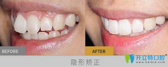 长沙雅美口腔刘景医生隐形牙齿矫正案例效果图