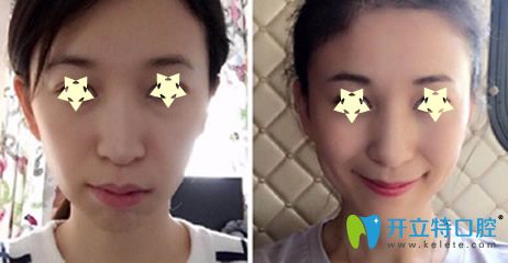 乐乐欣口腔段斌骨性龅牙隐形矫正案例