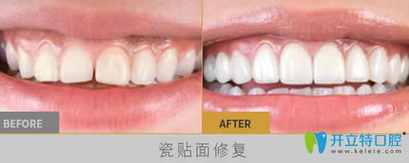 长沙雅美口腔刘景牙齿瓷贴面修复效果对比图