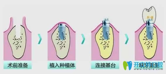 即刻种植牙步骤