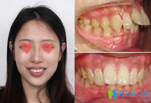 龅牙妹找长沙雅美口腔刘景医生做隐形牙齿矫正前后效果图
