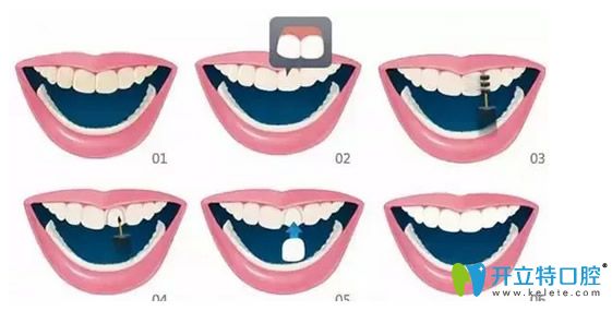 牙齿瓷贴面的过程