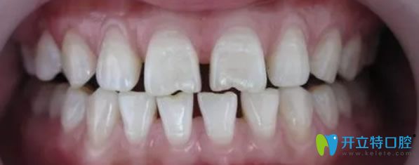 隐形牙齿矫正三个月的恢复效果图