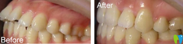 龅牙矫正前后效果对比案例