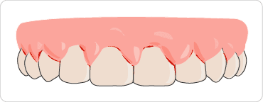 牙龈萎缩图示