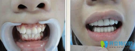 长沙牙大夫口腔周权牙齿矫正案例效果图 长沙牙大夫口腔周权牙齿矫正案例效果图