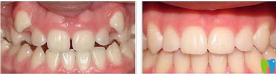 维乐口腔隐适美矫正牙齿13个月效果对比图