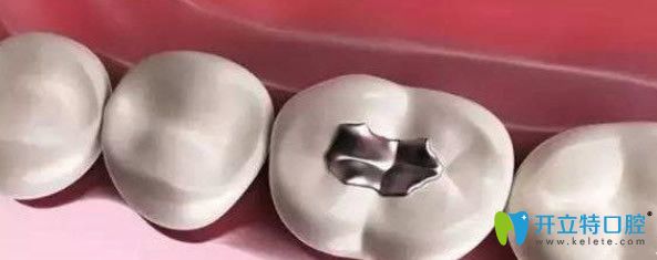 银汞合金是传统的后牙充填材料