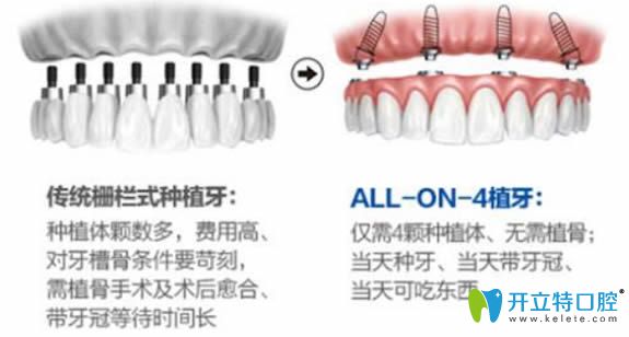 全口种植牙的价格需要多少钱,有allon4/6即刻种植牙费用详情