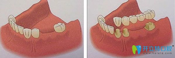 活动假牙的修复过程