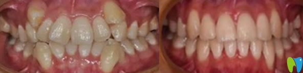 35岁牙齿矫正前后效果对比图