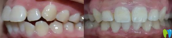 龅牙矫正代表案例