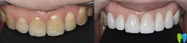 无锡博奥口腔瓷贴面修复四环素牙代表案例