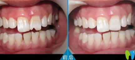 瓜子牙修复前后效果对比图